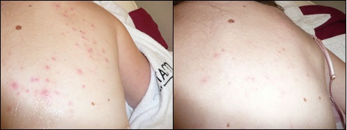 IPL treatment before and after